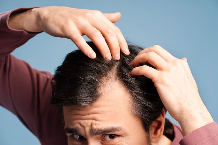 Bello Capello: Clinical Applications of Oral Minoxidil and Biotin for Hair Regrowth